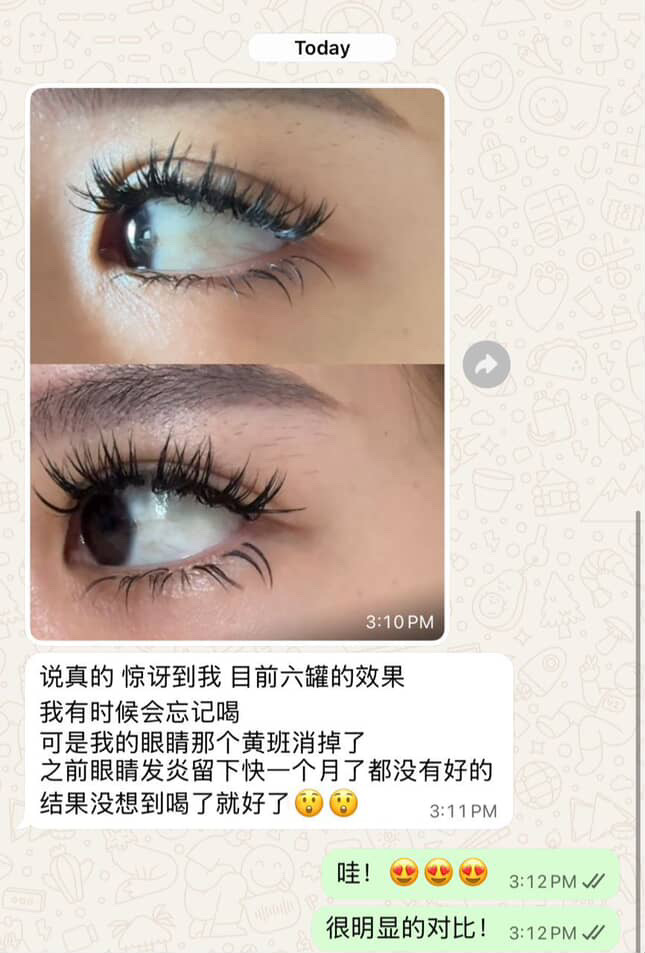 Eye close-up showing improvement after 6 ampoules